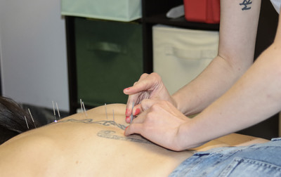 A woman's back is exposed on a table with a series of acupuncture needles going down her spine, two hands place another needle below the others. 